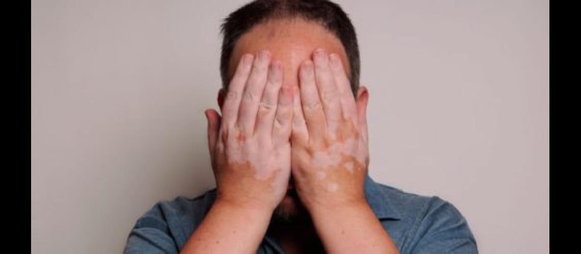 vitiligo