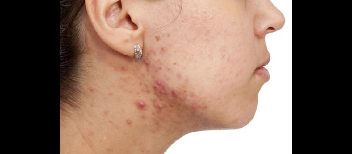 hidradenitis