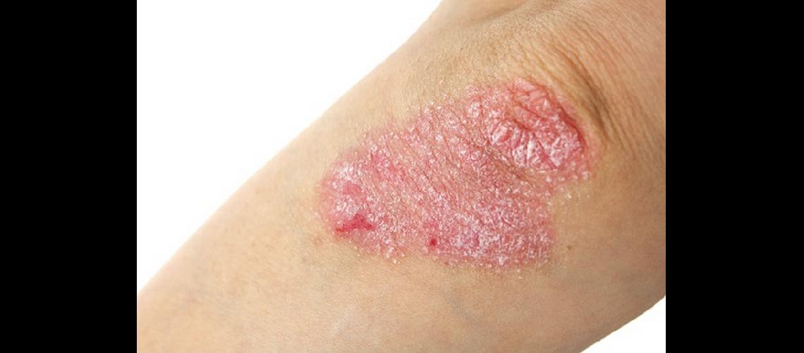 La deteccioacuten de la psoriasis resulta clave