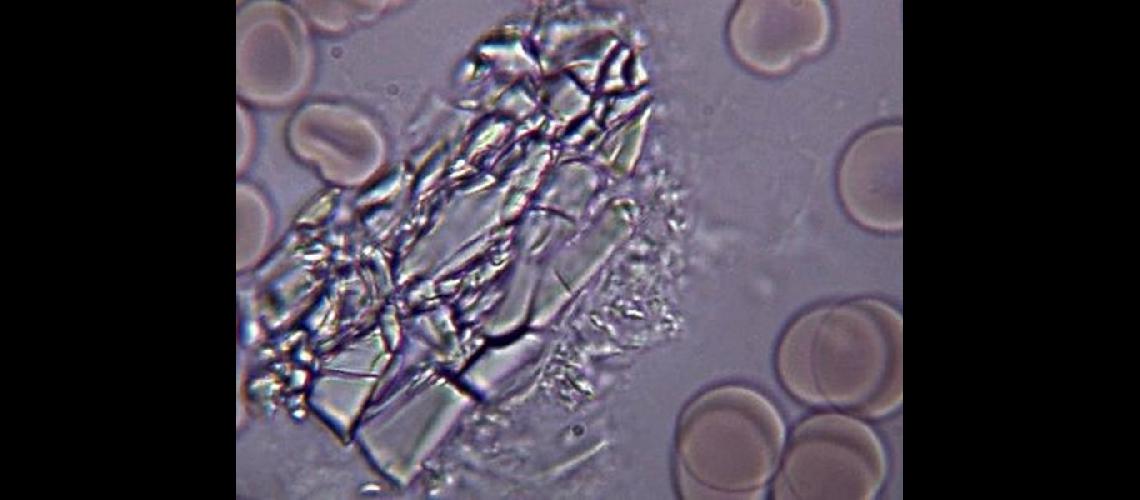 El colesterol en forma de cristales un gran generador de ataques cardiacuteacos