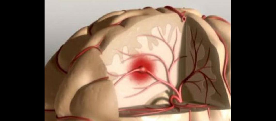 El accidente cerebro vascular se puede prevenir