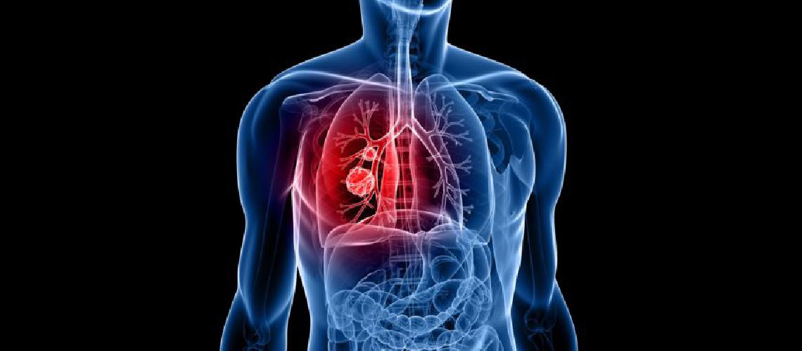 Un tratamiento reduce en 50-en-porciento- el riesgo de muerte por caacutencer de pulmoacuten