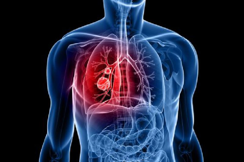 Un tratamiento reduce en 50-en-porciento- el riesgo de muerte por caacutencer de pulmoacuten