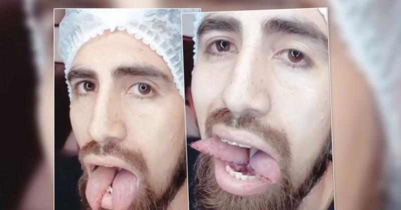 Así quedó la lengua del ex jugador de Lanús