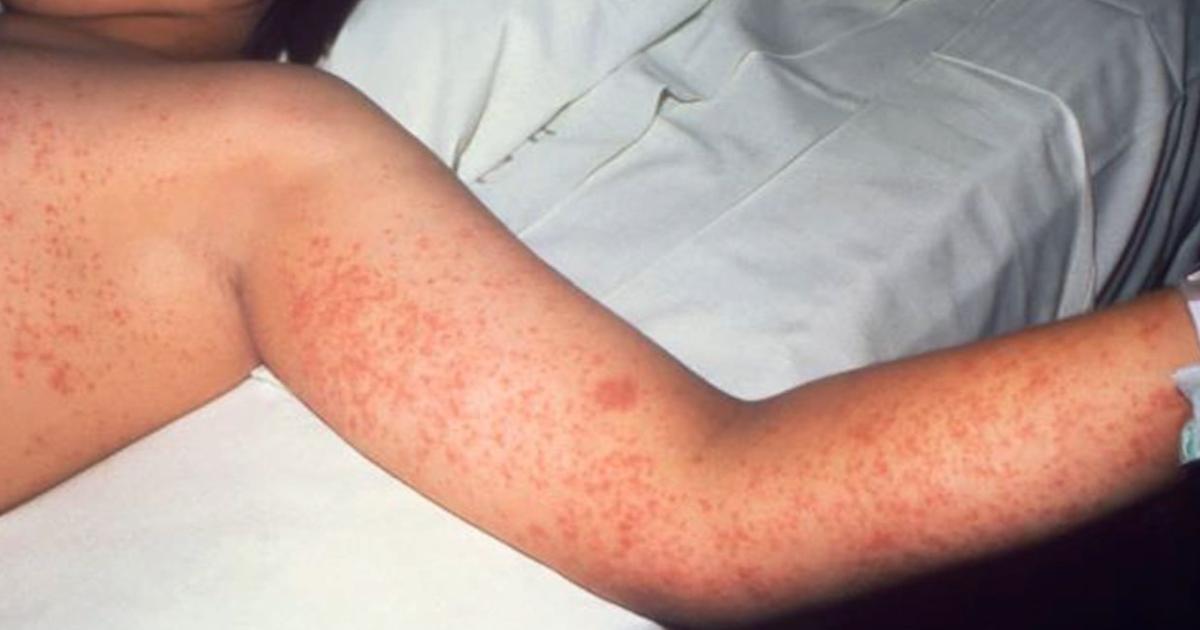 El sarampión es una enfermedad altamente contagiosa
