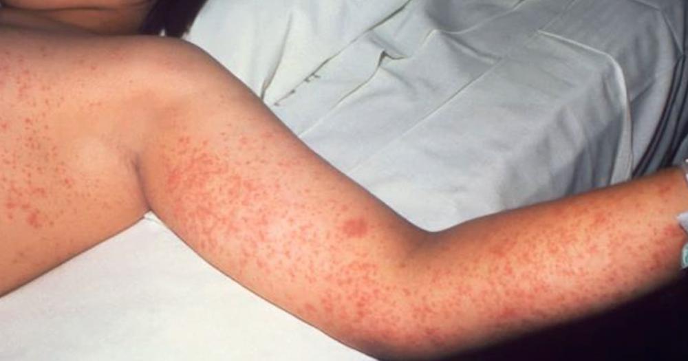 El sarampión es una enfermedad altamente contagiosa