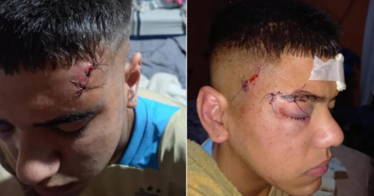 Thoms Fernndez recibió varios puntos de sutura por la salvaje agresión